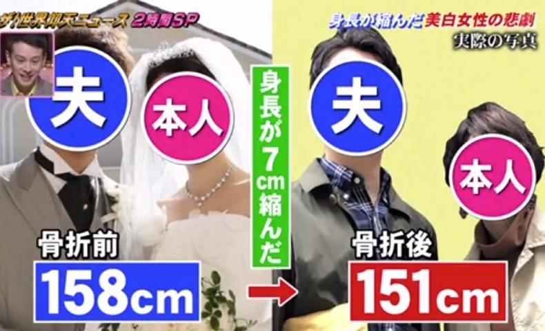 过度防晒致翻身骨折