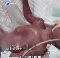 奇迹诞生！25周超早产儿只有巴掌大小，生命顽强震撼全网