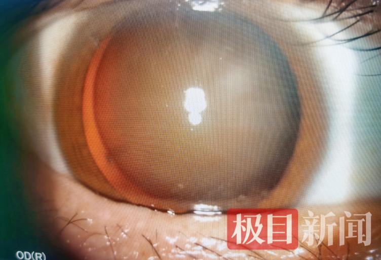 震惊！警员视力矫正后因难忍副作用自尽，背后真相令人痛心